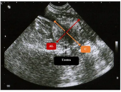 Figura 12 – Medições efetuadas no plano longitudinal da ultrassonografia prostática. 