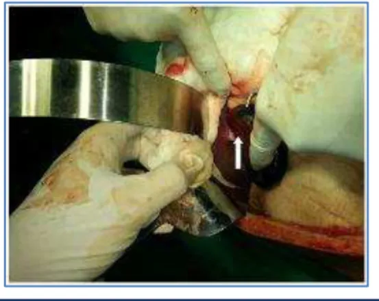 Fig. 3: Gangrenous gall bladder with  long mesentry (Floating gall bladder) 