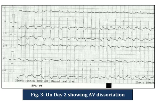 Fig. 3: On Day 2 showing AV dissociation 