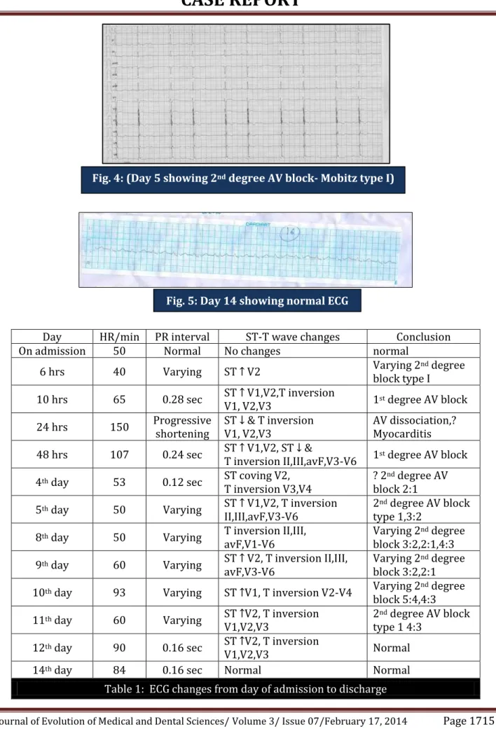 Table 1:  ECG changes from day of admission to discharge Fig. 4: (Day 5 showing 2nd  degree AV block- Mobitz type I)