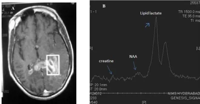 Figure 2: Singal voxel localizer (rectangle) placed on the lesion involving corpus callosum and periventricular white matter (A)