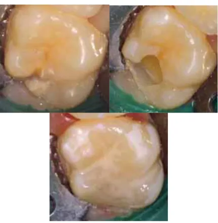 Figura 7. Primeiro molar permanente com restauração em resina composta  (Fonte: Daly &amp; Waldron, 2009) 