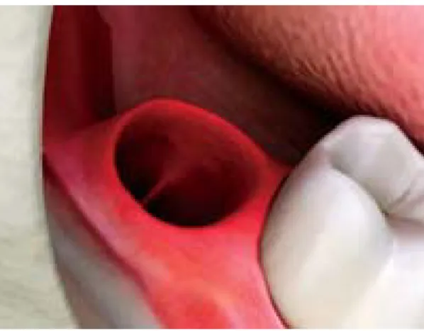 Ilustração  6.  Local  de  extracção  próximo  a  um  dente;  com  osso visível no alvéolo vazio, podendo existir exposição dos nervos aumentando a sensibilidade do paciente, cedido  por soft dental    