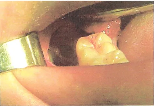 Ilustração 7. Alveolite Seca com alvéolo sem coágulo e com paredes ósseas desnudas, cedido por RCOE v. 7 nº  6, 2002   