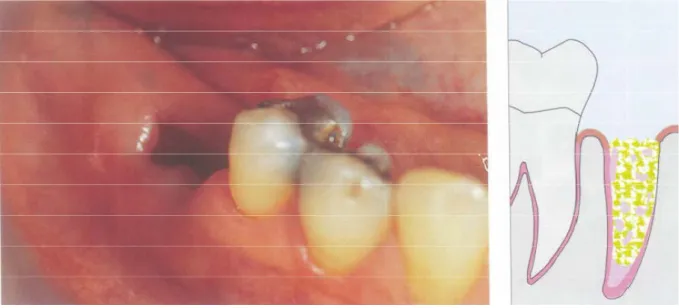Ilustração 8. Alvéolo com ausência de coágulo / Esquema relativo a acumulação de detritos no alvéolo, cedido por  Matteo Chiapasco, no livro Cirurgía oral texto y atlas en color, 2004