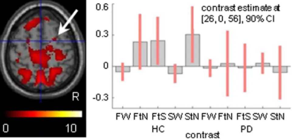 Figure 4. Right dorsal premotor responses in wide-field optic flow. Contrasting wide-field optic flow (FW) to a wide stationary field (SW) revealed a hardly detectable FW-related effect in the right dorsal premotor cortex of healthy controls (HC) by a thre