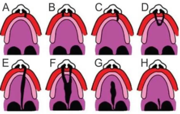 Figura 1- Representação das fendas lábio palatinas de acordo com a classificação de Spina et al