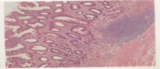 Table  1  represented  the  clinical  data  of  our  86  dyspeptic  patients.  On  the  basis  of  histological  appearances      in      multiple        endoscopical      biopsies  (Fig