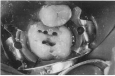 Figura 1 Primeiro molar inferior com 5 canais (DeGrood and Cunningham, 1997) 