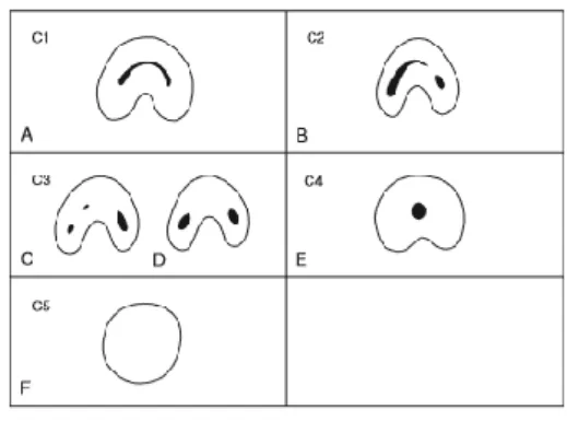 Figura 6 Classificação da configuração dos canais em &#34;c&#34; ( cit. in Cohen, 2016)