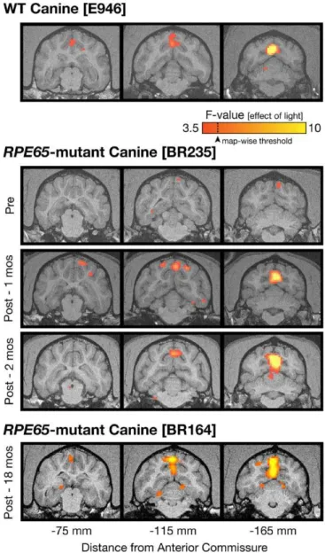 Figure 2. fMRI Responses in RPE65-Mutant Dogs before and after Gene Therapy
