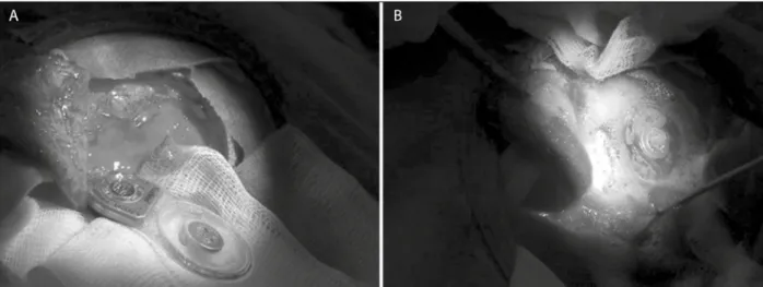 Figure 5. A) Infected implant removed; B) Implant bathed in a 3% hydrogen peroxide solution