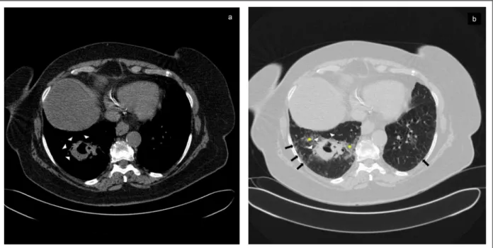 FIGure 1. Bronchocentric granulomatosis presenting as a thick-walled cavity. 