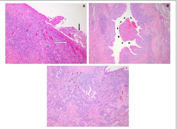 FIGure 2. Major histopathological findings in bronchocentric granulomatosis (BcG).
