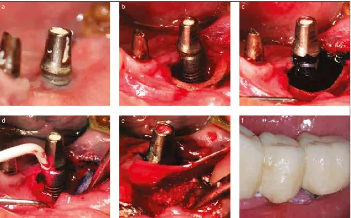 Figure 1. Surgery procedure using PDT for decontamination implant surface: a) peri-implantitis around the implant in function; b) peri-implant  defect; c) application of photosensitizer (HELBO® Blue); d) activation of photosensitizer by using diode laser; 