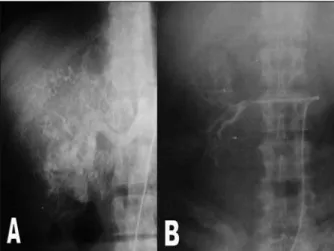 FIGURE 6.  Angiography of a hypervascularised right renal carcinoma. 