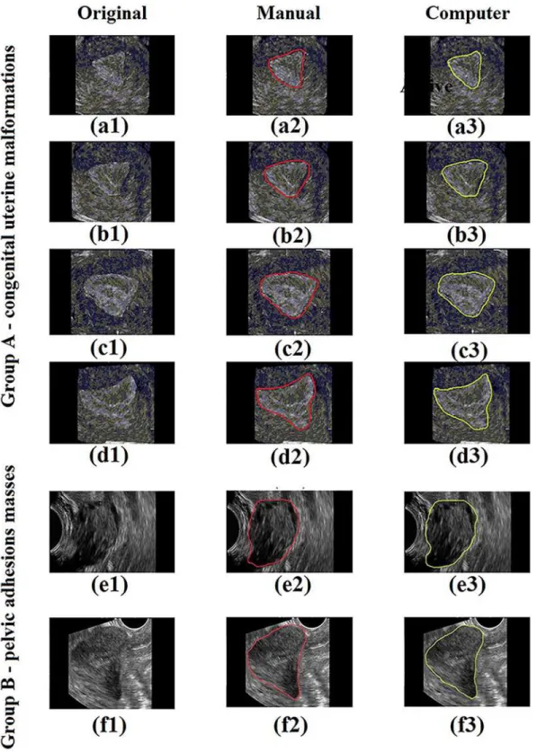 Fig 3. Gynecology ultrasound scans with segmentation of uterus by active contour model