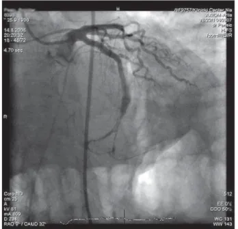 Figure 4. TIMI 3 flow after the predilatation of the lesion and of both  side branches