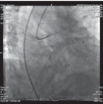 Figure 7. Final result: TIMI 3 flow after post dilatation of the bare-metal  stent Driver 3.0×18 implanted in the target lesion