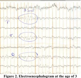 Figure 2. Electroencephalogram at the age of 3  