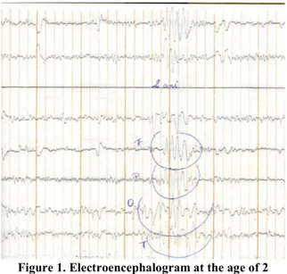 Figure 1. Electroencephalogram at the age of 2 