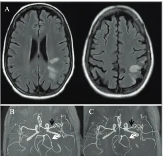 FIGURE 1.  A (MRI in T2 FLAIR sequence) shows multiple ischemic lesions in different vascular territories, suggesting cerebral vasculitis