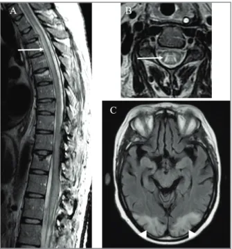 FIGURE 2.  A and B (MRI in T2 FSE sequence) show abnormal hyperintense signal of spinal cord (arrow), at C4 axial level (A) and extending longitudinally through thoracic spinal cord (B).