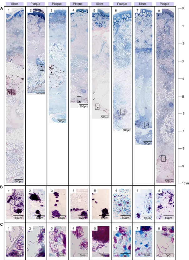 Fig 2. Localisation of large clusters of AFB in the subcutis of BU lesions. Histological sections were stained with ZN (counterstain methylenblue)
