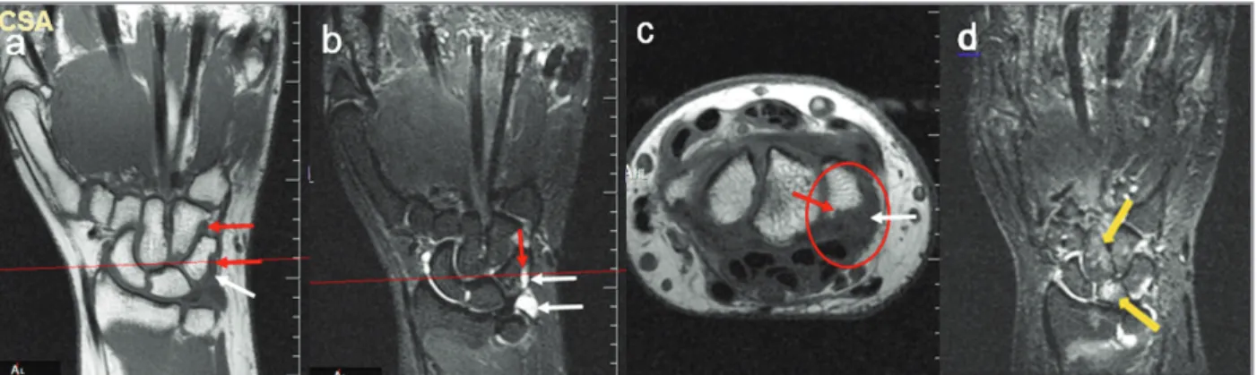 fIgure 1. Hand-wrist MRI Coronal T1 and STIR in a clinically suspicious arthralgia (CSA) patient