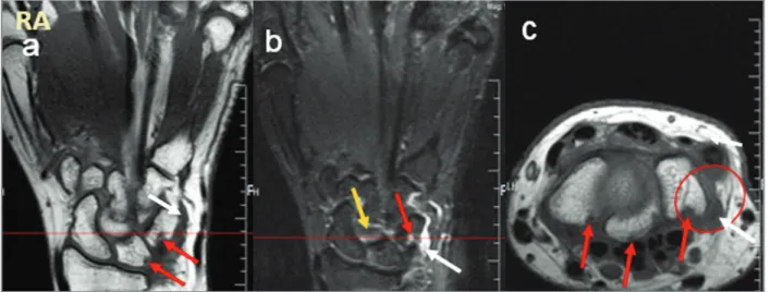 fIgure 3. Hand-wrist MRI Coronal T1 and STIR in a rheumatoid arthritis (RA) patient. First Carpal line lesions in a 45 year-old woman