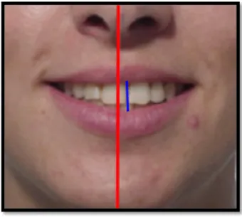 Figura  2  -  Desvio  da  linha  média  dentária  (Azul)  em  relação  a  linha  média  facial  (Vermelha)