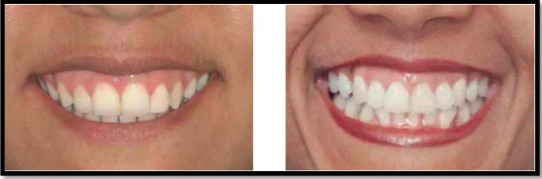 Figura  11  -  Pacientes  com  lábios  finos  e  hiperativos,  contribuindo  para  uma  maior  exposição gengival ao sorrir
