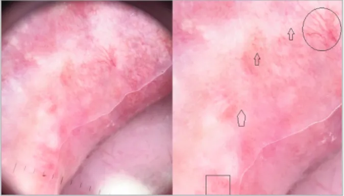 FIGure 1. Oral aphthous ulcer: a central white structureless area surrounded by a white collarette (arrow) as well as coiled