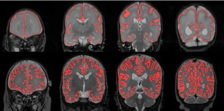 Fig 1. Automatic segmentation of CoGM at 30 (top) and 40 weeks PMA (bottom) for the same patient, shown in four slices of the T2-weighted images