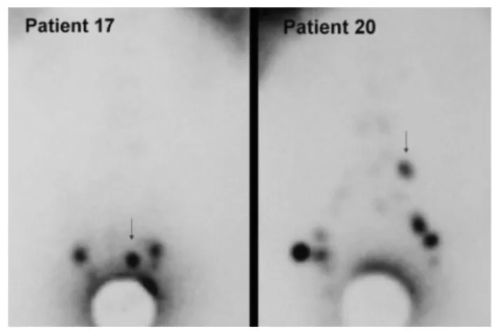 Abbildung 2: Prozentsatz der durch SLND detektierten Lymphknoten- Lymphknoten-metastasen in Abhängigkeit vom Tumorstadium (n = 161 Patienten) Abbildung 1a und 1b: Pelvine Lymphszintigramme 3 Stunden nach trans-rektaler intraprostatischer Injektion von 99mT