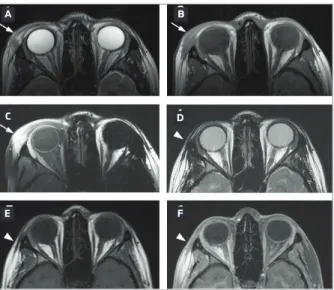 FIGURE 1. Diagnostic MRI with axial T2WI (A), axial T1WI (B), and axial contrast enhanced T1WI (C) shows a poorly defined mass in the external periorbital region, with heterogeneous T2 signal intensity and avid enhancement (arrows)
