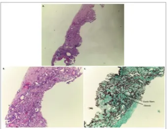 FIGure 2. Section of upper lobe biopsy showing: (A, B) visceral pleura fibrosis and homogeneous dense subpleural fibrosis with prominent elastosis (C)