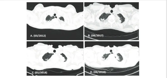 FIGure 3. Evolution of thoracic imaging by High Resolution Computed Tomography (HRCT) over time (axial images)