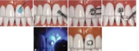 Fig.  26 :  Método  de  fixação  de  um  bracket.  Adaptado: Romman (2011).