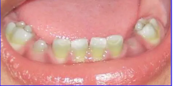Fig 1: Clinical appearance of the lower primary teeth at 17 month of age, demonstrating green    pigmentation 
