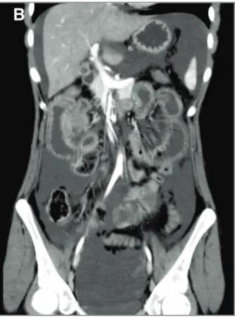 fIGure 1.  Abdominal US (A) and CT (B) from Patient 1 showing similar findings: moderate ascites, increased wall thickening of the colon with abnormal enhancement (target sign) and increased reflectivity of subjacent fat tissue.