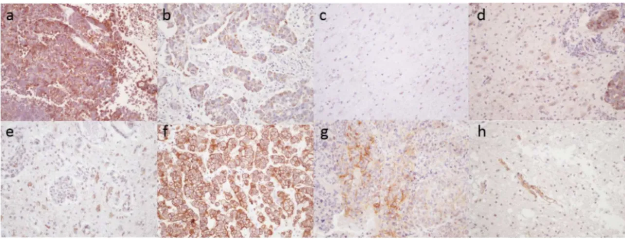 Fig 1. Expression of LAT1 and CD98 in brain metastases and in non-tumoral brain: a) strong and diffuse expression of LAT1 in a BM from small cell lung carcinoma, b) heterogeneous staining of LAT1 in a BM of lung squamous cell carcinoma, c) non-tumoral brai