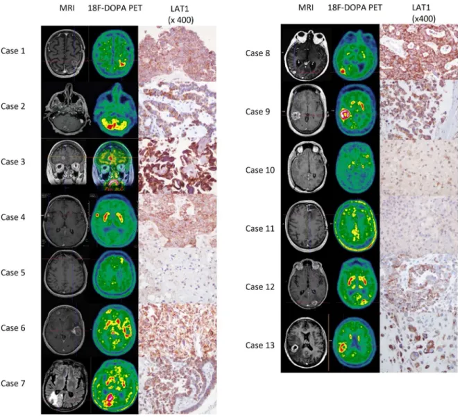 Fig 2. correlation between [18F] FDOPA PET imaging and LAT1 expression in recurrent BM after radiotherapy and in radionecrosis
