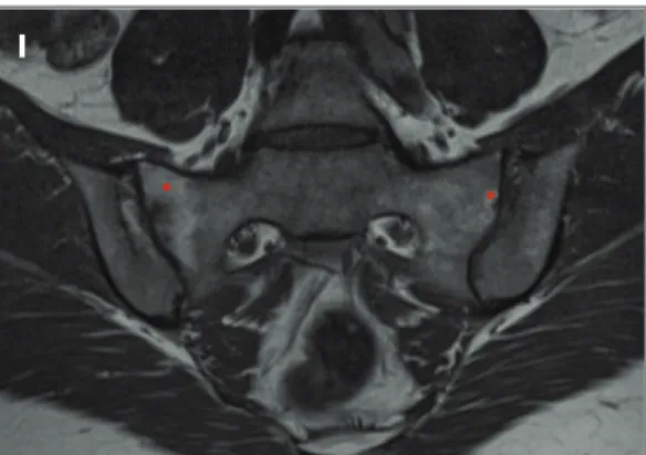 FIGurE 3. Chronic post-structural lesions on MRI as defined by ASAS criteria. 31-year-old female, ankylosing spondylitis: A) coronal oblique T1W and B) coronal oblique FS T2W MR images show subchondral sclerosis (arrows in A), with joint space narrowing, m
