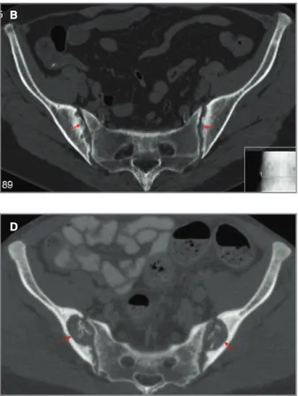 fIgure 6.  Secondary hyperparathyroidism. 49-year-old female, chronic renal disease: A) AP pelvic radiograph and B) axial CT image show bilateral sclerosis of the SIJs (arrowheads in A) and subchondral bone reabsorption/erosions, more evident on the right 