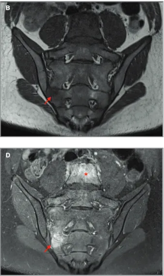 fIgure 7. SAPHO and CRMO. 40-year old female, SAPHO: A) AP pelvic radiograph shows marked hyperostosis of the right SIJ (asterisks) with cortical erosions