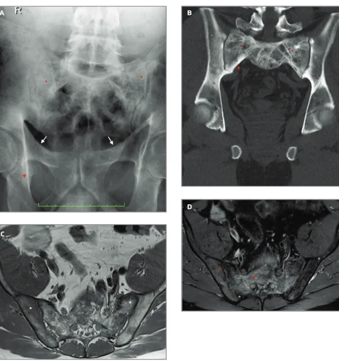 fIgure 8. Paget’s disease. 58-year-old male: A) AP pelvic radiograph reveals trabecular coarsening of the sacrum (asterisks), thickening of the right ischiopubic line (red arrowhead) and, to a lesser degree, of the iliopectineal line (white arrows)