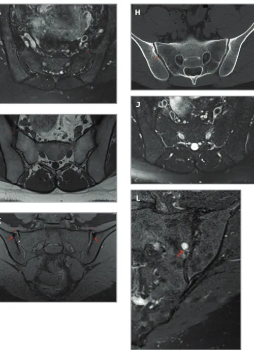 fIgure 1. Degenerative changes. 64-year-old woman, pain not fulfilling definition for inflammatory low back pain: A) coronal CT image, B) coronal oblique T1W and C) coronal oblique FS PDW MR images show subchondral sclerosis, more evident on the right ilia