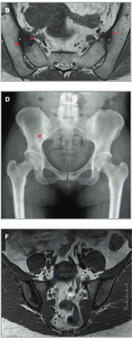 fIgure 3. Osteitis condensans ilii.  32-year-old male, long- long-standing lumbar pain: A) axial CT image, B) axial oblique T1W and C) axial oblique FS T2W MR images show bilateral anterior well-circumscribed triangular area of subchondral sclerosis (aster