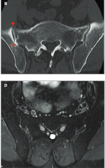 fIgure 5.  DISH. 52-year-old male, DISH: A) sagittal CT image of the lumbar spine shows flowing consecutive osteophytes (arrowheads), with disk space sparing; B) axial CT image of the SIJs shows posterior bone bridging (arrow) and anterior osteophytosis (a